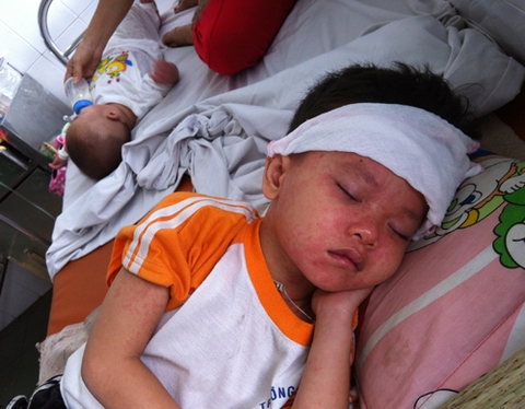 Cách phân biệt bệnh sởi với sốt phát ban